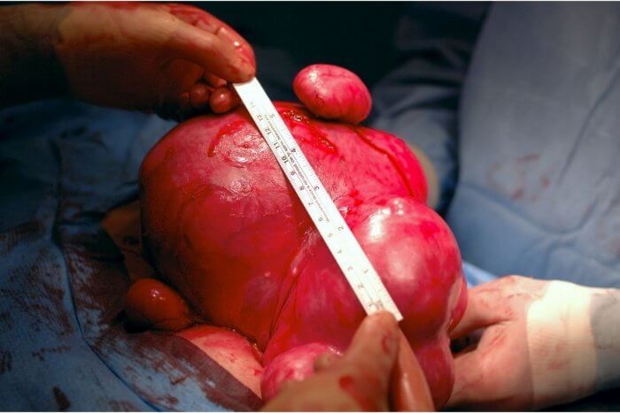 Surgeons holding a large fibroid just removed in an operating theatre to measure the size - both large and small sized fibroids can cause Fibroid Pain