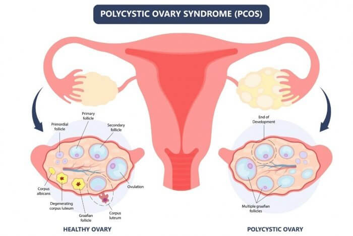 What is PCOS Graphic showing the womb with a healthy ovary on L side and polycystic ovary on R side.