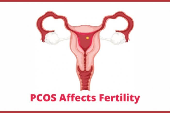 PCOS Affects Fertility graphic showing the womb and healthy ovaries