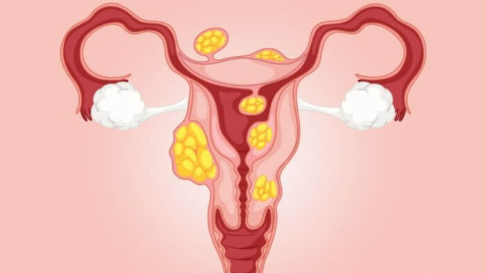 Natural treatments for fibroids