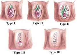 Classification of Female Genital Mutilation