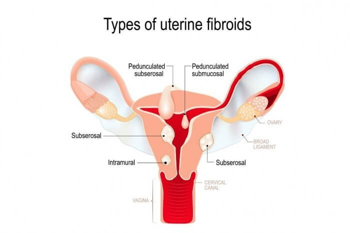 Image of types of Fibroids - Location can help indicate what does Fibroid Pain feel like
