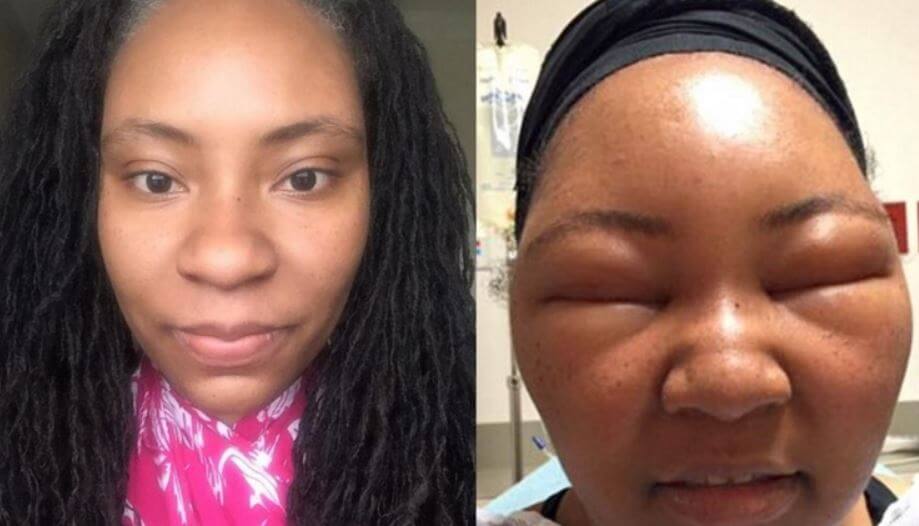 Before and After photos of a lady of african background with an allergy reaction from hair dye