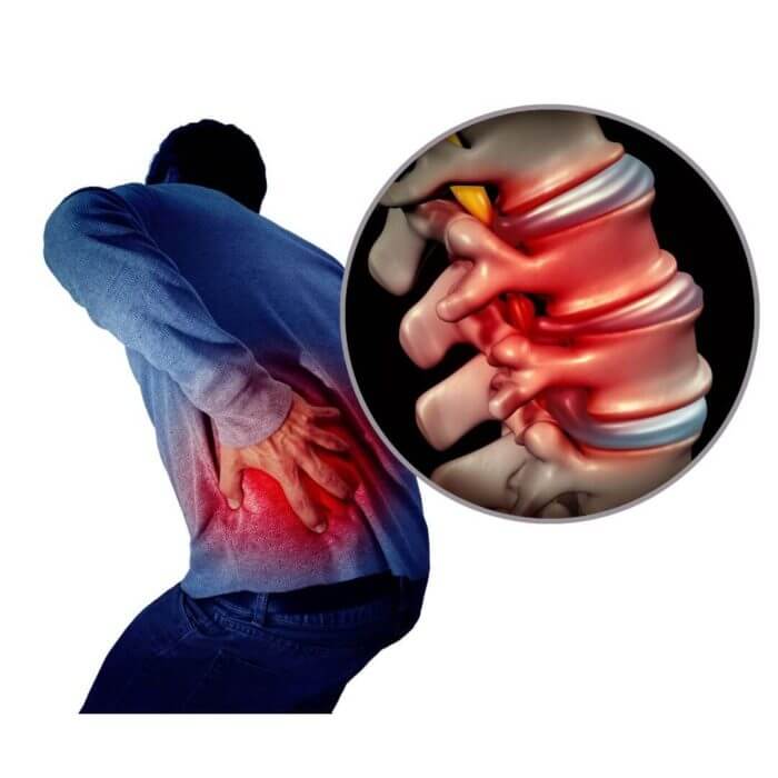 Man bent over in pain to the L side of his back